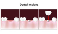 There is no reason to have missing teeth!